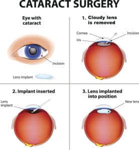 Cataract procedure