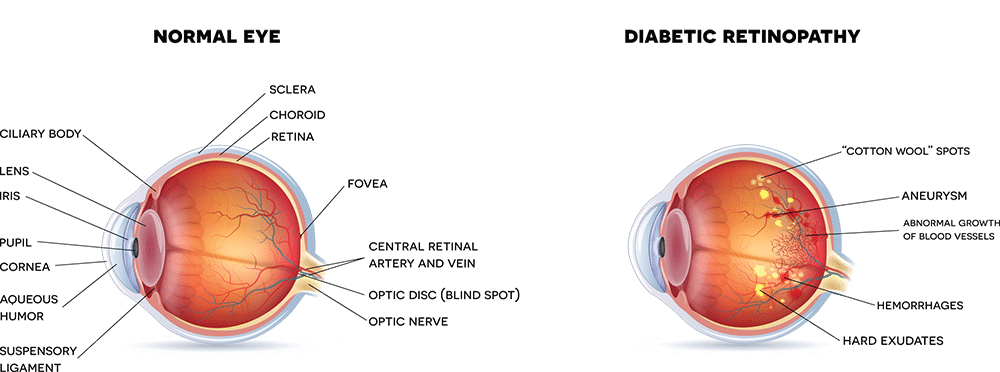 Diabetic Eye Disease e1486168998886