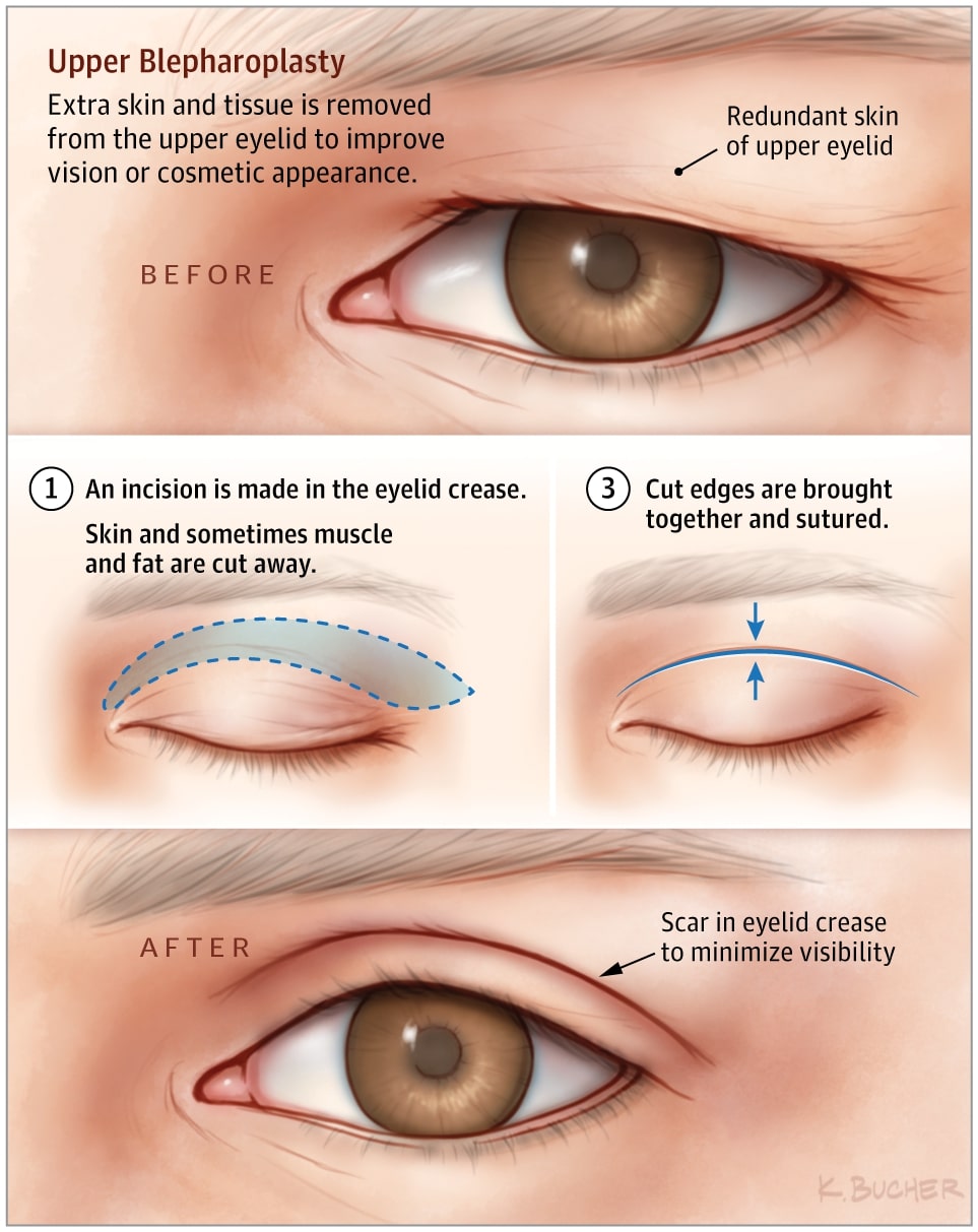 blepharoplasty
