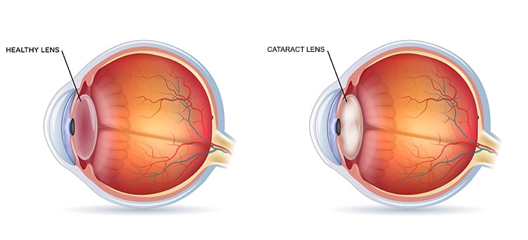 diagnosis cataract