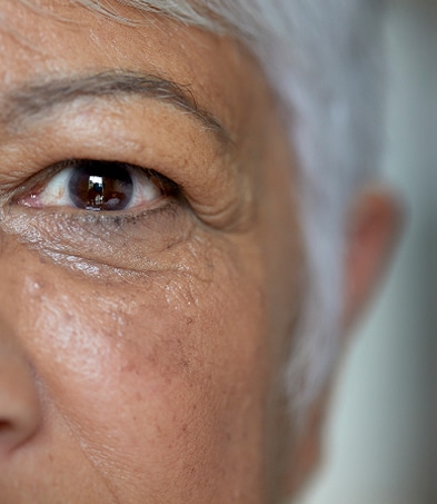 Cataract Surgery
