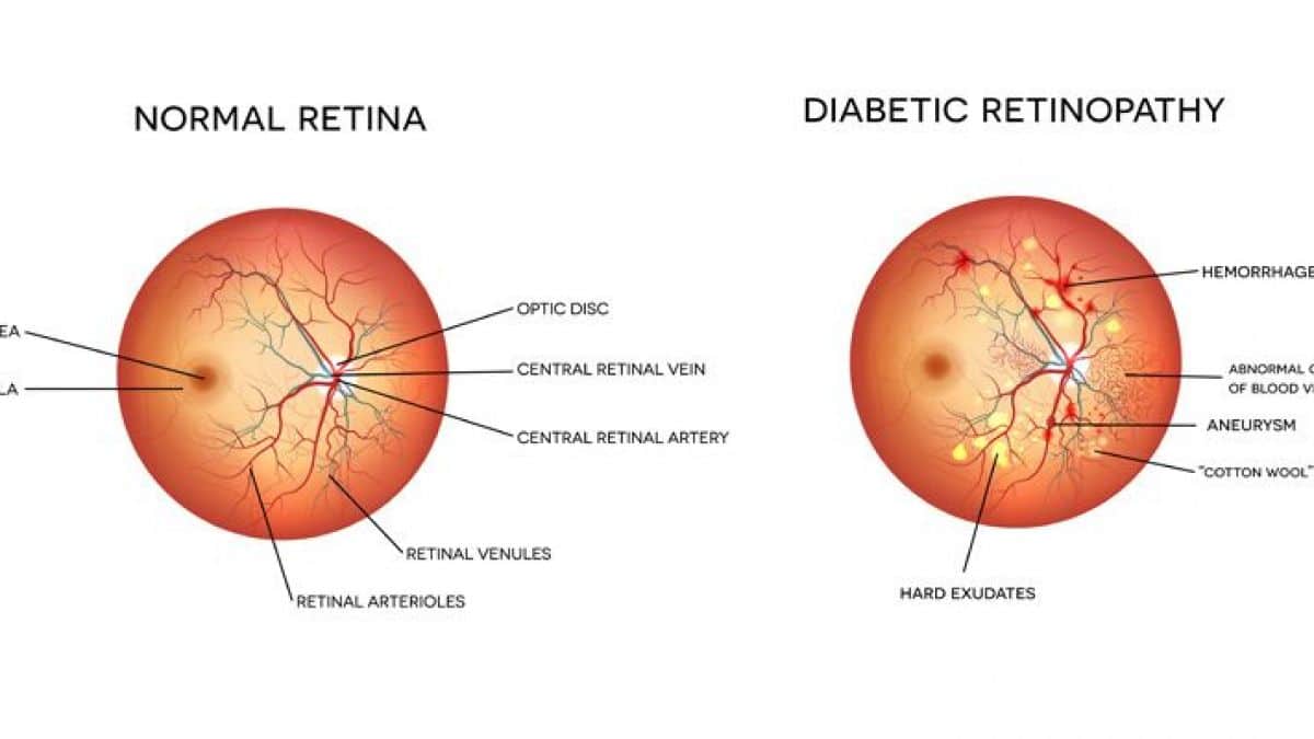 diabetic rethonopaty 1200x675 1