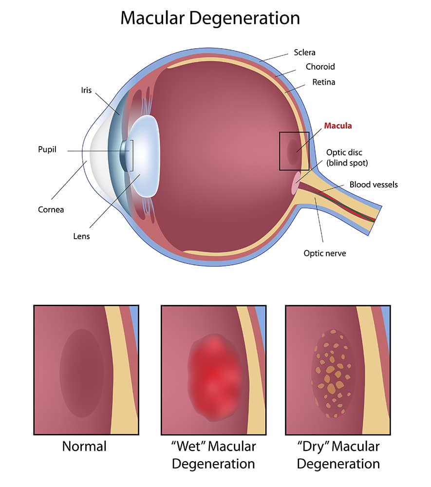 macular deg